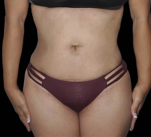 After abdominal contouring, real patient of Dr. Hankins
