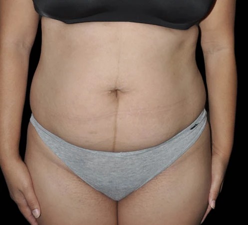 Before abdominal contouring, real patient of Dr. Hankins