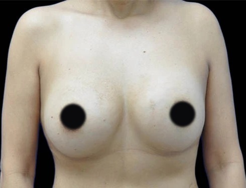 After breast augmentation, real patient of Dr. Hankins