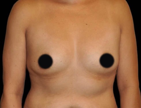 Before breast augmentation, real patient of Dr. Hankins