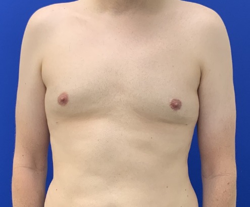 After gynecomastia surgery, real patient of Dr. Hankins