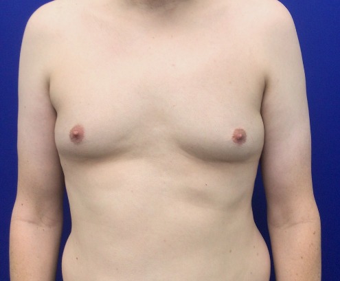 Before gynecomastia surgery, real patient of Dr. Hankins