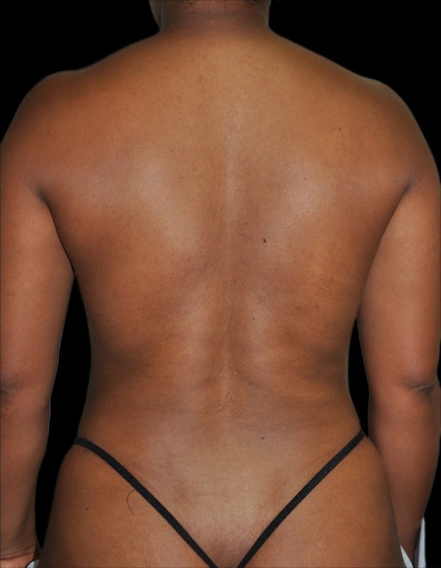 After liposuction, real patient of Dr. Hankins
