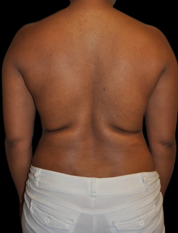 Before liposuction, real patient of Dr. Hankins