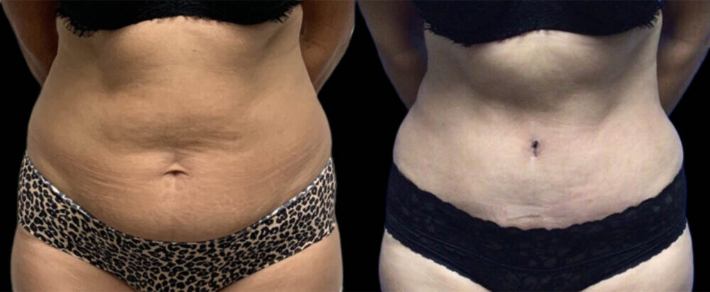 Tummy Tuck case #3128