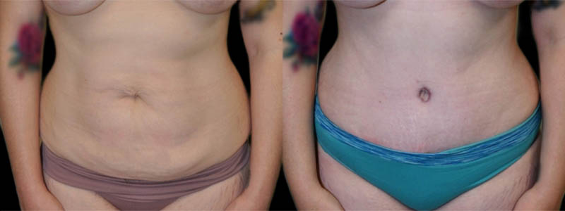 Tummy Tuck case #3139