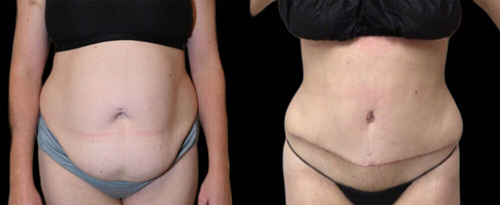 Tummy Tuck case #3143