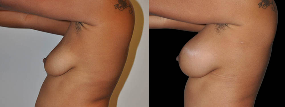 Breast Augmentation case #3191