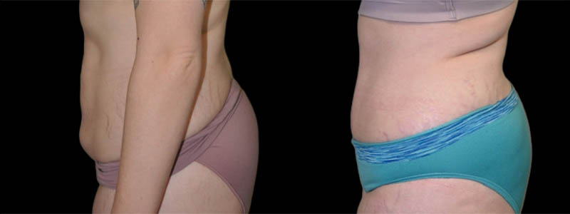 Tummy Tuck case #3139