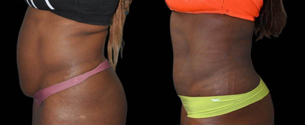 Tummy Tuck case #3132