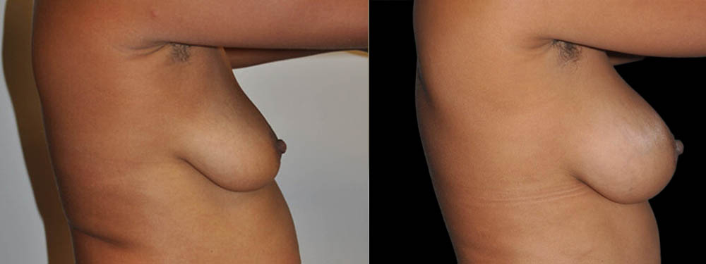 Breast Augmentation case #3191