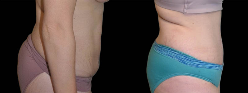 Tummy Tuck case #3139