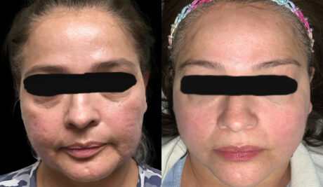 Secret RF Microneedling case #3337