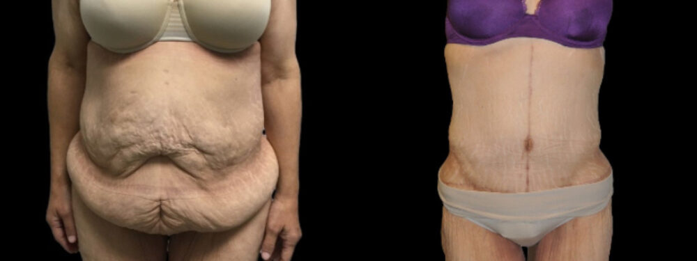 Tummy Tuck case #3101