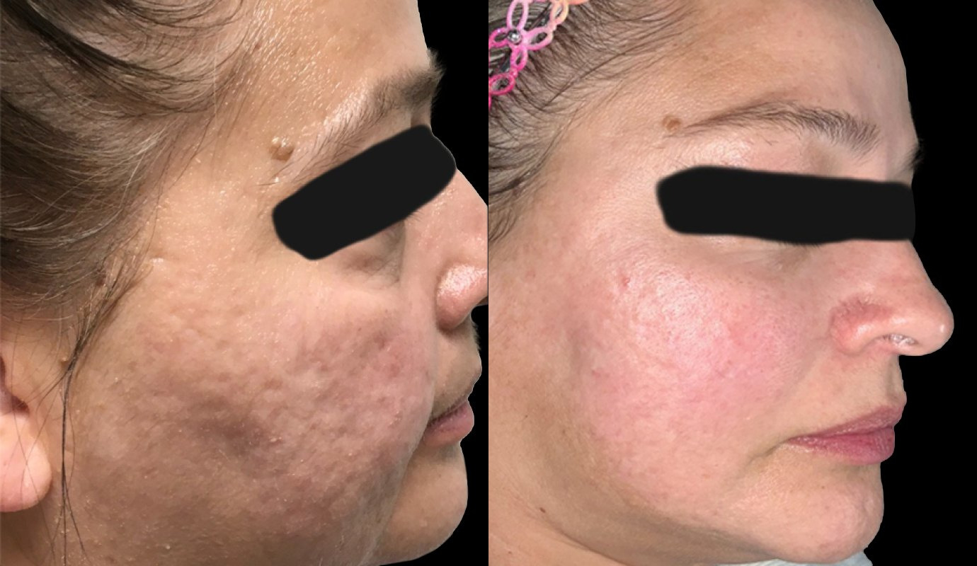 Secret RF Microneedling case #3337