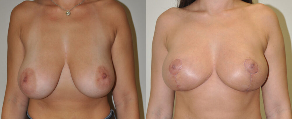 Breast Reduction case #3264