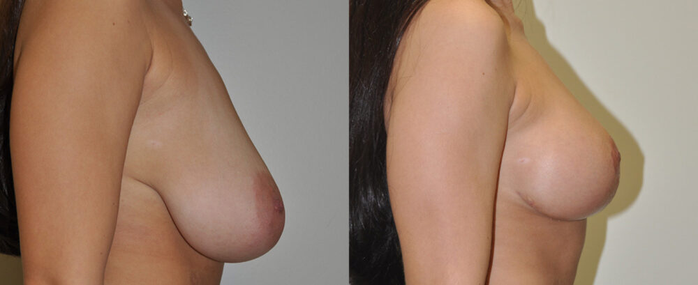 Breast Reduction case #3264