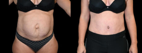 Tummy Tuck case #3149