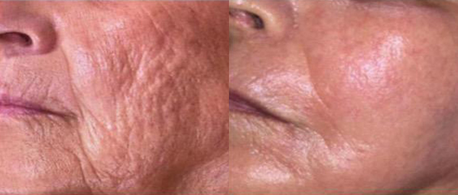 Secret RF Microneedling case #3340