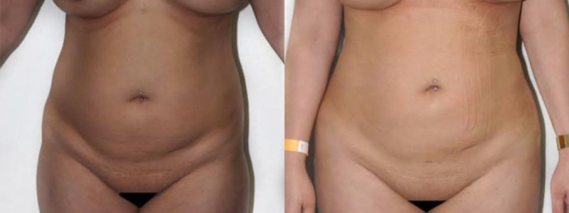 Liposuction case #3465