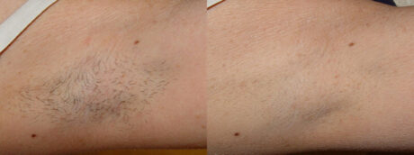 Spider Vein Treatment case #3505