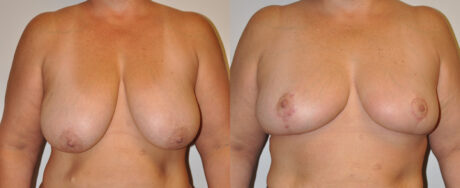 Breast Reduction case #3230