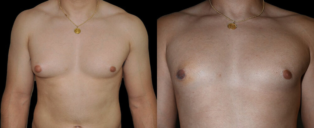 Gynecomastia case #3301