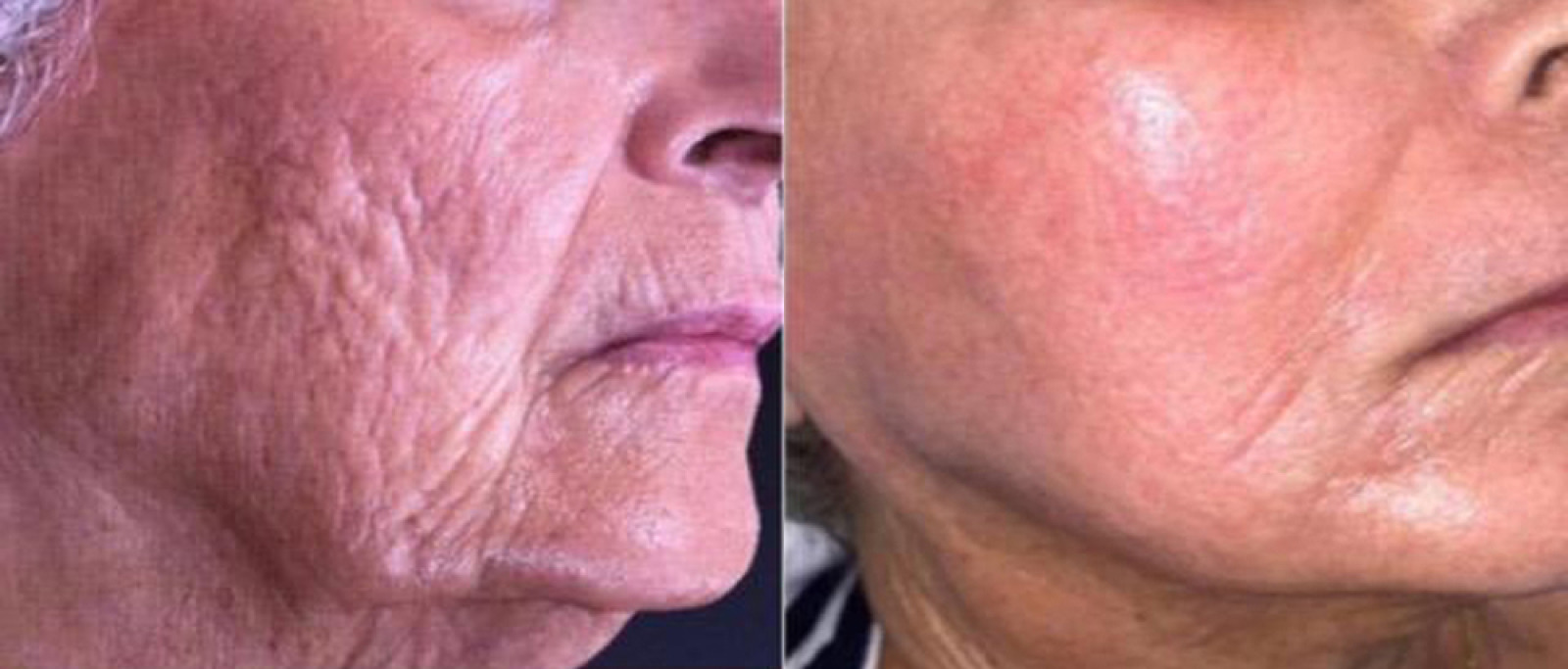 Secret RF Microneedling case #3340