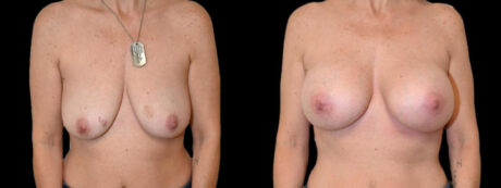 Breast Augmentation case #3187