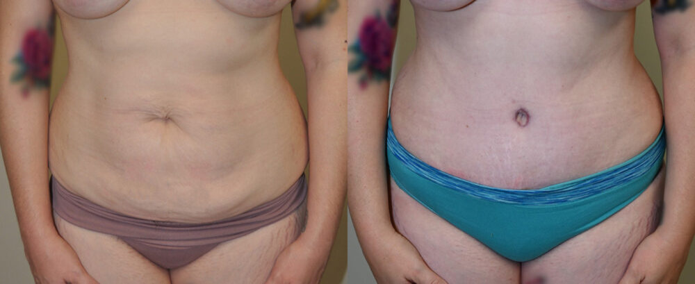 Tummy Tuck case #3111