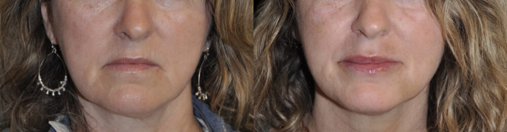 Facial Fillers case #3296