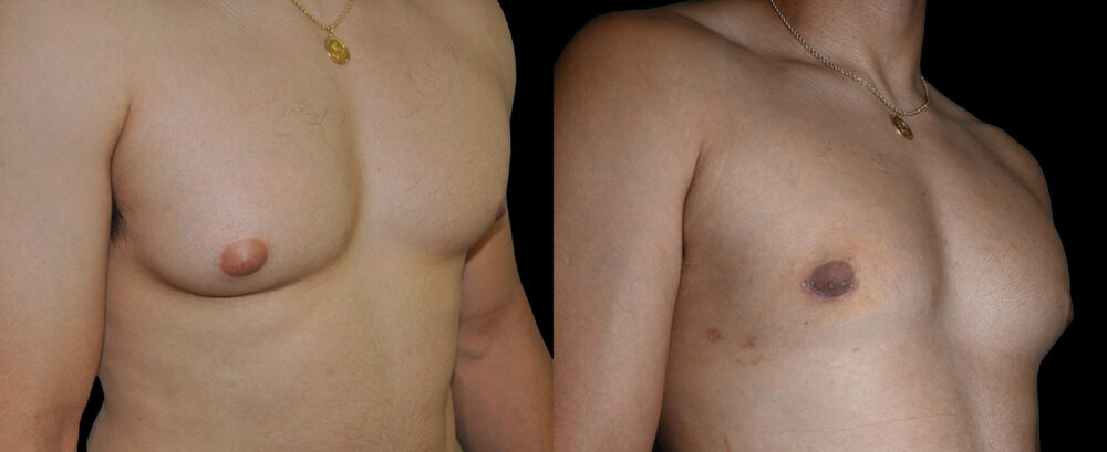 Gynecomastia case #3303