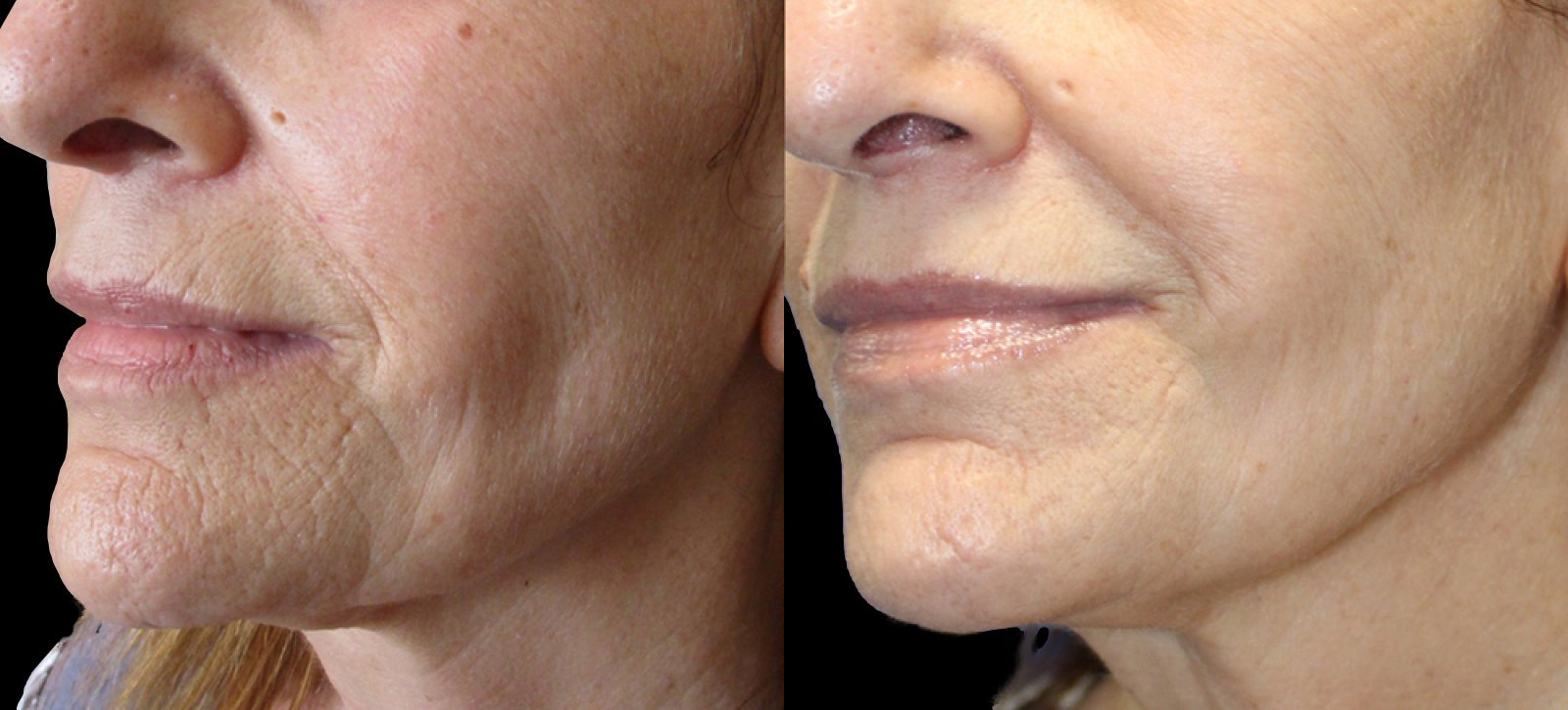 Secret RF Microneedling case #3342