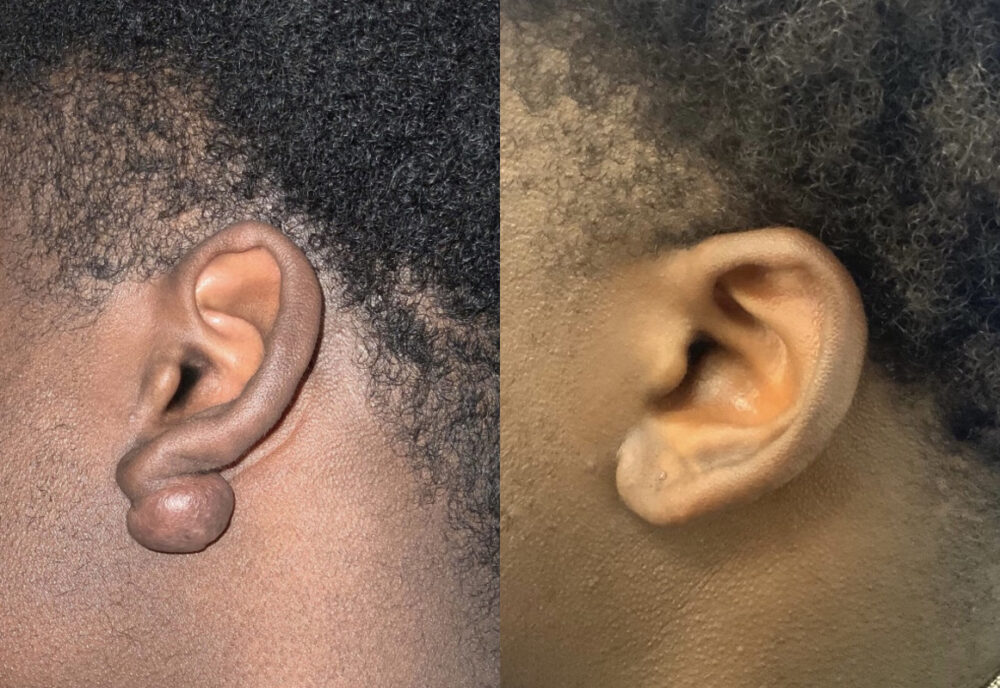 Keloid Scar Treatment case #3370