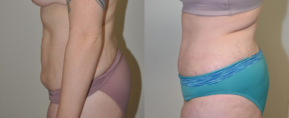 Tummy Tuck case #3111