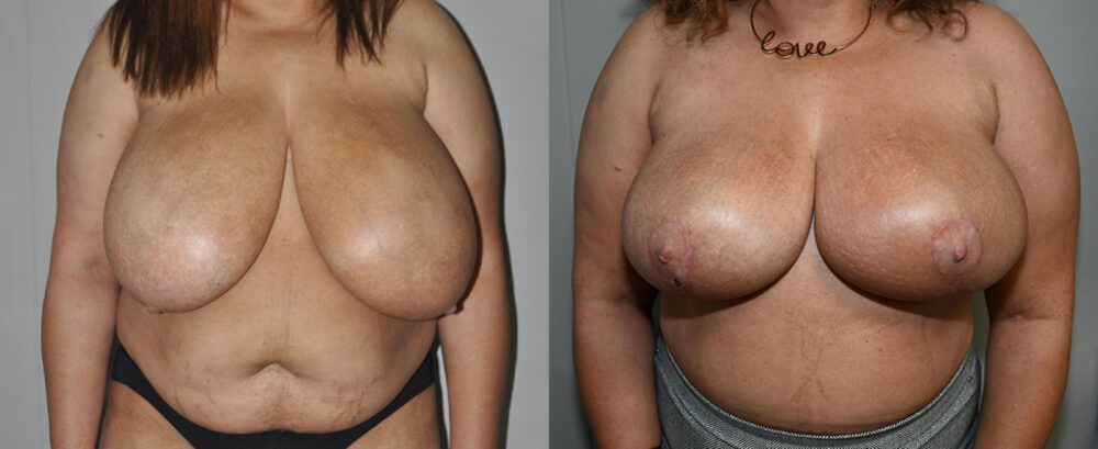 Breast Reduction case #3238