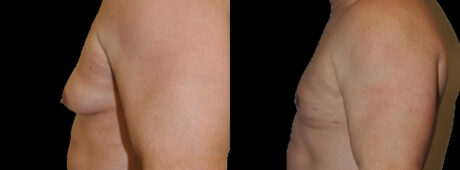 Gynecomastia case #3305