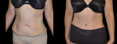 Tummy Tuck case #3115