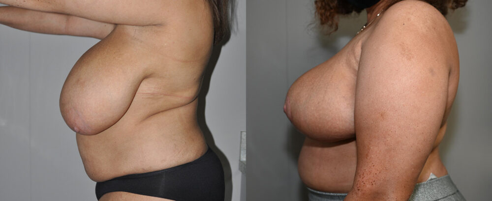 Breast Reduction case #3238