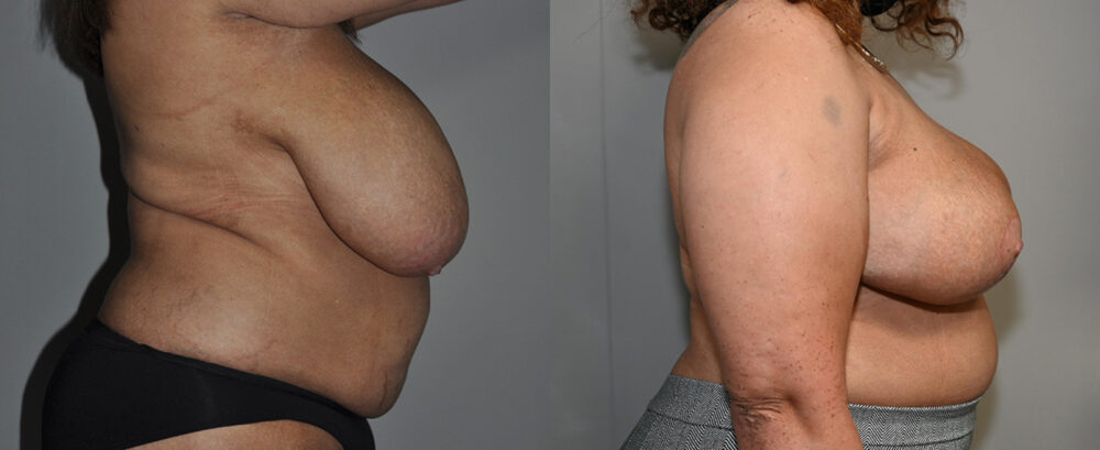 Breast Reduction case #3238