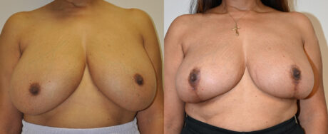 Breast Reduction case #3242