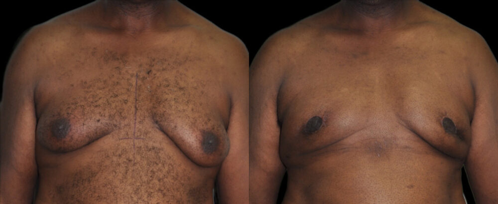 Gynecomastia case #3307