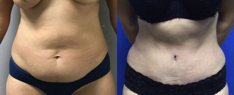 Tummy Tuck case #3124