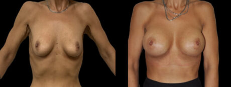 Breast Augmentation case #3201