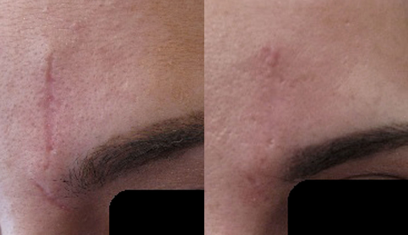 Secret RF Microneedling case #3349