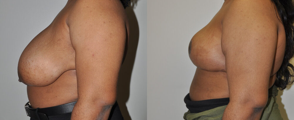 Breast Reduction case #3249