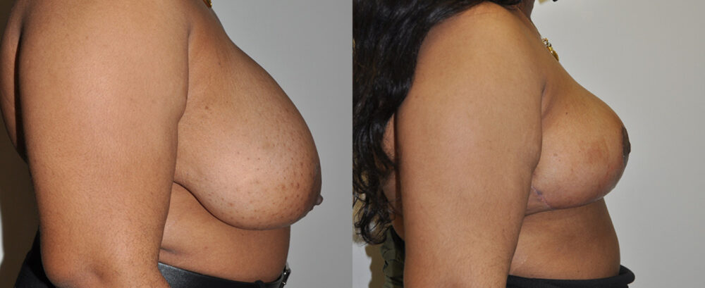 Breast Reduction case #3249