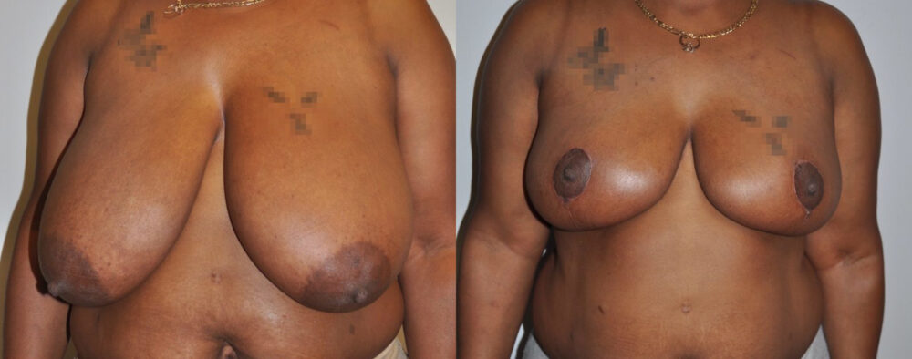 Breast Reduction case #3256