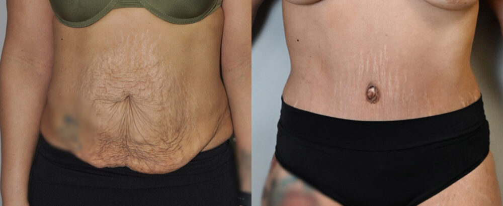 Tummy Tuck case #3136