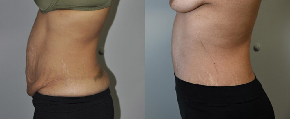 Tummy Tuck case #3136